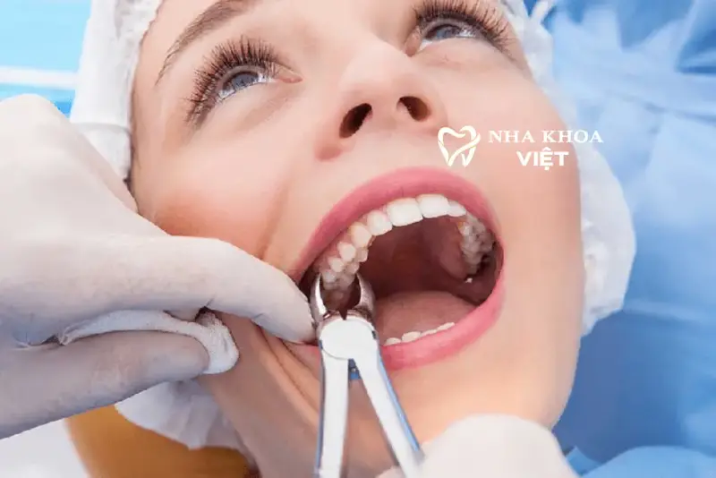 Dịch vụ nhổ răng, nhổ răng sữa, nhổ răng khôn