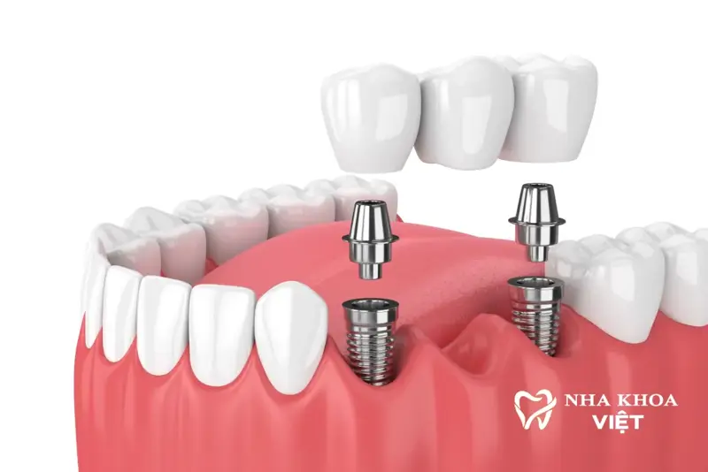 Dịch vụ nha khoa trồng răng implant là gì? Khi nào thì nên trông răng implant, có những công nghệ trồng răng implant nào?