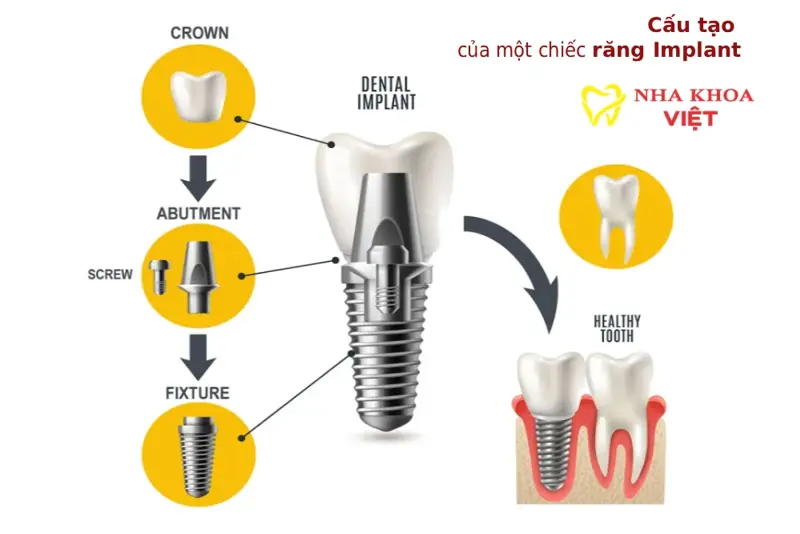 Quy trình 5 bước khi trồng răng Implant tại Nha Khoa Việt